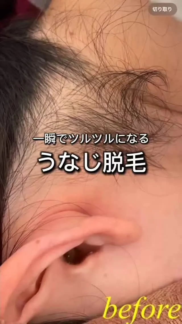 一瞬で綺麗になるうなじWAX脱毛💜ᩚ