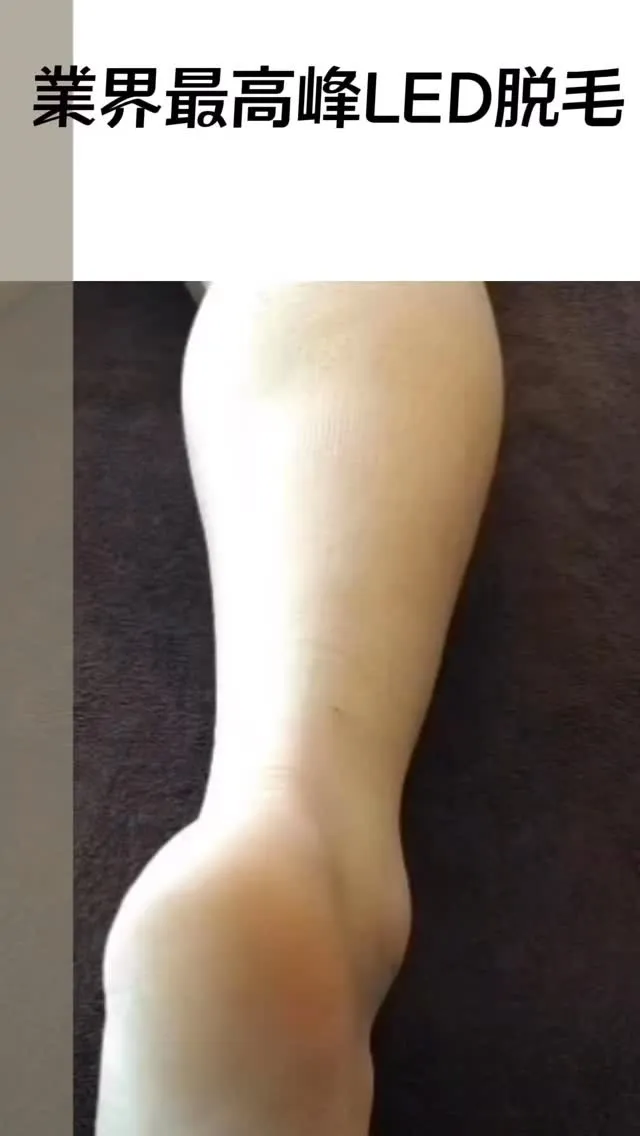 効果のある脱毛方法で痛くないキッズ脱毛は秋から始めると得する理由